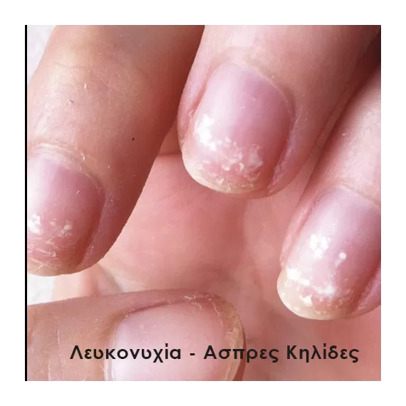 λευκονυχία- ασπρεσ κηλίδες