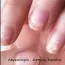 λευκονυχία- ασπρεσ κηλίδες